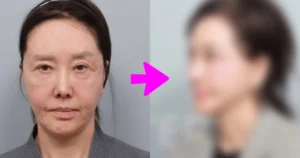 61-Year-Old Actress Shocks With New Face After Cosmetic Procedures