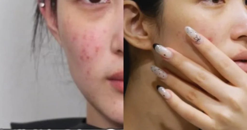 Former LABOUM Member Yulhee Undergoes Transformative Skin and Facial Analysis, Revealing Impact of Motherhood and Misguided Self-Care Habits