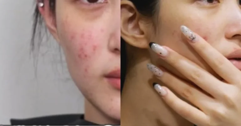 former-laboum-member-yulhee-undergoes-transformative-skin-and-facial-analysis-revealing-impact-of-motherhood-and-misguided-self-care-habits
